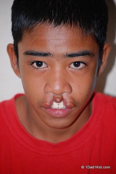 Ian with cleft lip