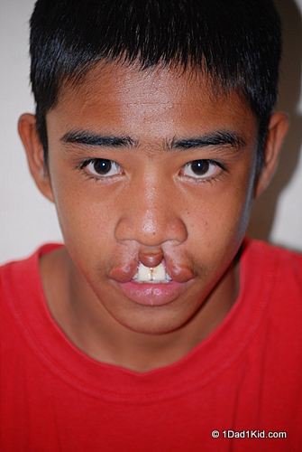 cleft lip, philippines