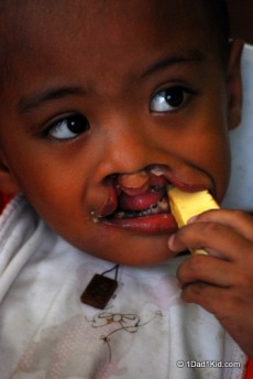 Child with cleft lip and palate
