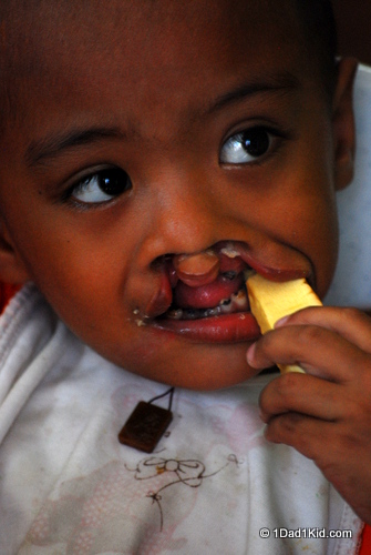 cleft lip, cleft palate, philippines, uplift