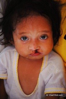 Child with cleft lip