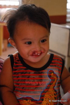 Baby with cleft lip
